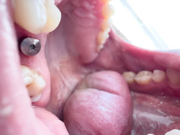 Open mouth at the doctor with titanium dental implant