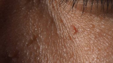 Siğil yüzünde. Gözün yanında siğil iğnesi var. Göz ve boyun çevresinde papilloma var. Doğum lekesi Papilla 'ya ya da derisindeki bene yakın dur. Küçük sert. Deride iyi huylu bir büyüme. Virüs yüzünden. Cilt bakımı.