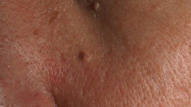 Siğil yüzünde. Gözün yanında siğil iğnesi var. Göz ve boyun çevresinde papilloma var. Doğum lekesi Papilla 'ya ya da derisindeki bene yakın dur. Küçük sert. Deride iyi huylu bir büyüme. Virüs yüzünden. Cilt bakımı.