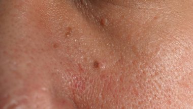 Siğil yüzünde. Gözün yanında siğil iğnesi var. Göz ve boyun çevresinde papilloma var. Doğum lekesi Papilla 'ya ya da derisindeki bene yakın dur. Küçük sert. Deride iyi huylu bir büyüme. Virüs yüzünden. Cilt bakımı.