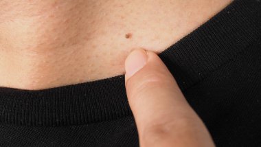 Siğil yüzünde. Gözün yanında siğil iğnesi var. Göz ve boyun çevresinde papilloma var. Doğum lekesi Papilla 'ya ya da derisindeki bene yakın dur. Küçük sert. Deride iyi huylu bir büyüme. Virüs yüzünden. Cilt bakımı.