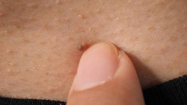 Siğil yüzünde. Gözün yanında siğil iğnesi var. Göz ve boyun çevresinde papilloma var. Doğum lekesi Papilla 'ya ya da derisindeki bene yakın dur. Küçük sert. Deride iyi huylu bir büyüme. Virüs yüzünden. Cilt bakımı.