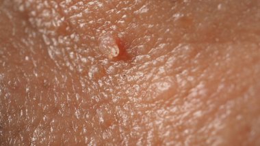 Siğil yüzünde. Gözün yanında siğil iğnesi var. Göz ve boyun çevresinde papilloma var. Doğum lekesi Papilla 'ya ya da derisindeki bene yakın dur. Küçük sert. Deride iyi huylu bir büyüme. Virüs yüzünden. Cilt bakımı.