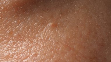 Siğil yüzünde. Gözün yanında siğil iğnesi var. Göz ve boyun çevresinde papilloma var. Doğum lekesi Papilla 'ya ya da derisindeki bene yakın dur. Küçük sert. Deride iyi huylu bir büyüme. Virüs yüzünden. Cilt bakımı.