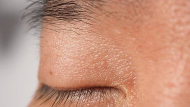 Siğil yüzünde. Gözün yanında siğil iğnesi var. Göz ve boyun çevresinde papilloma var. Doğum lekesi Papilla 'ya ya da derisindeki bene yakın dur. Küçük sert. Deride iyi huylu bir büyüme. Virüs yüzünden. Cilt bakımı.