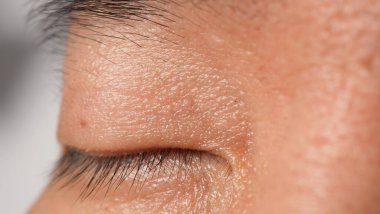 Siğil yüzünde. Gözün yanında siğil iğnesi var. Göz ve boyun çevresinde papilloma var. Doğum lekesi Papilla 'ya ya da derisindeki bene yakın dur. Küçük sert. Deride iyi huylu bir büyüme. Virüs yüzünden. Cilt bakımı.