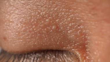 Siğil yüzünde. Gözün yanında siğil iğnesi var. Göz ve boyun çevresinde papilloma var. Doğum lekesi Papilla 'ya ya da derisindeki bene yakın dur. Küçük sert. Deride iyi huylu bir büyüme. Virüs yüzünden. Cilt bakımı.