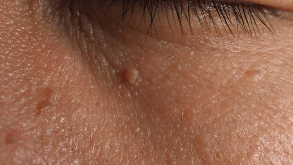Wart Face 近视时的疣状物巨拍 眼鼻和颈部周围皮肤上的乳头状瘤 靠近皮肤上的胎记 乳头或痣 有点硬 皮肤的良性生长 是由病毒引起的护肤 — 图库照片