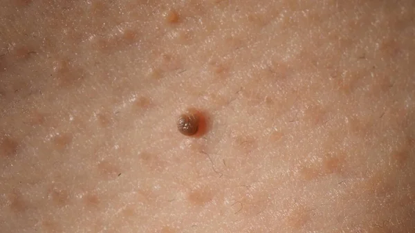 Wart Cara Macro Inyección Verruga Cerca Del Ojo Papiloma Piel —  Fotos de Stock