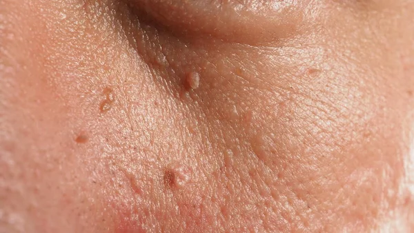 Wart Face 近视时的疣状物巨拍 眼鼻和颈部周围皮肤上的乳头状瘤 靠近皮肤上的胎记 乳头或痣 有点硬 皮肤的良性生长 是由病毒引起的护肤 — 图库照片
