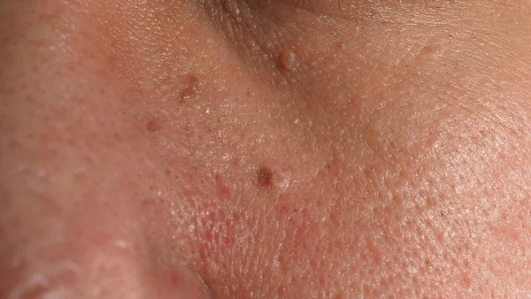 Wart Face Macro Shot Wart Eye Papilloma Skin Eye Nose — Stock Photo, Image