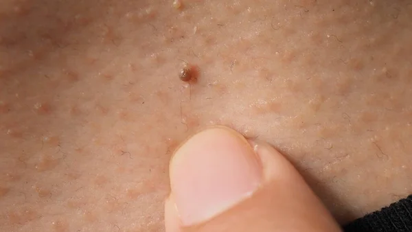 Wart Cara Macro Inyección Verruga Cerca Del Ojo Papiloma Piel —  Fotos de Stock