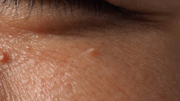 顔を警戒しろ 眼の近くでのウォートのマクロショット 鼻や首の周りの皮膚上の乳頭腫 皮膚の上の母斑パピラまたはモルの閉鎖 小さなハード 肌に優しい成長 ウイルスによるものです スキンケア — ストック写真