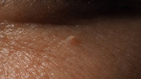 Wart Cara Macro Inyección Verruga Cerca Del Ojo Papiloma Piel —  Fotos de Stock