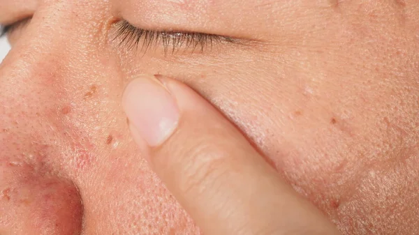 Wart Face Macro Shot Wart Eye Papilloma Skin Eye Nose — Stock Photo, Image