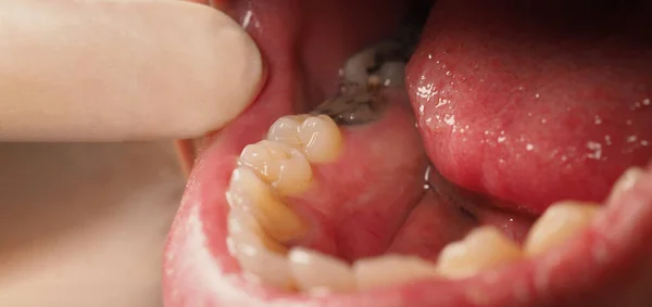 Decayed tooth root canal treatment. Tooth or teeth decay of lower molar. Restoration with a composite filling. Adult caries. bad teeth. Dental temporary restorative material. Dental concept. close up.