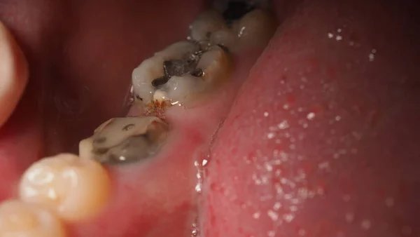 Decayed tooth root canal treatment. Tooth or teeth decay of lower molar. Restoration with a composite filling. Adult caries. bad teeth. Dental temporary restorative material. Dental concept. close up.