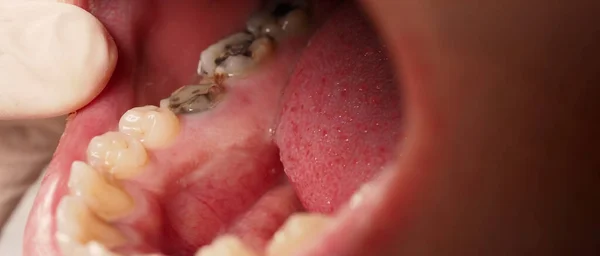 Karies Wurzelkanalbehandlung Zahn Oder Zähne Zerfall Der Unteren Molaren Restaurierung — Stockfoto