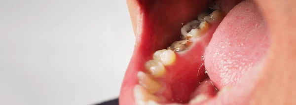 虫歯歯根管治療 歯や歯の下部臼歯の崩壊 複合充填と復元 大人の世話だ 悪い歯だ 歯の一時的な修復材料 歯の概念 閉めて — ストック写真