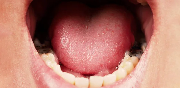 충치를 치료하는 치아의 응결핵의 화장에는 재료가 일시적 개념적 가까이 — 스톡 사진
