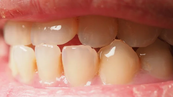 虫歯歯根管治療 歯や歯の下部臼歯の崩壊 複合充填と復元 大人の世話だ 悪い歯だ 歯の一時的な修復材料 歯の概念 閉めて — ストック写真