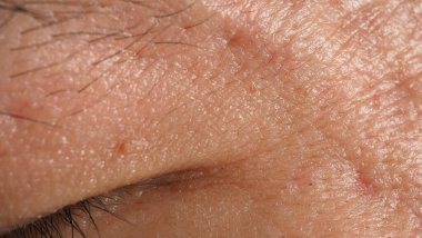 Siğil aldırma. Yüzüne yakın siğillerin makro görüntüsü. Göz ve boyun çevresinde papilloma var. Doğum lekesi Papilla ya da derisindeki ben. Küçük sert. Virüsün neden olduğu deride iyi huylu bir büyüme. Cilt bakımı
