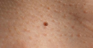 Siğil aldırma. Yüzüne yakın siğillerin makro görüntüsü. Göz ve boyun çevresinde papilloma var. Doğum lekesi Papilla ya da derisindeki ben. Küçük sert. Virüsün neden olduğu deride iyi huylu bir büyüme. Cilt bakımı