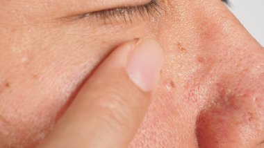 Siğil aldırma. Yüzüne yakın siğillerin makro görüntüsü. Göz ve boyun çevresinde papilloma var. Doğum lekesi Papilla ya da derisindeki ben. Küçük sert. Virüsün neden olduğu deride iyi huylu bir büyüme. Cilt bakımı