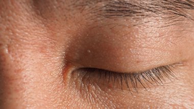 Siğil aldırma. Yüzüne yakın siğillerin makro görüntüsü. Göz ve boyun çevresinde papilloma var. Doğum lekesi Papilla ya da derisindeki ben. Küçük sert. Virüsün neden olduğu deride iyi huylu bir büyüme. Cilt bakımı