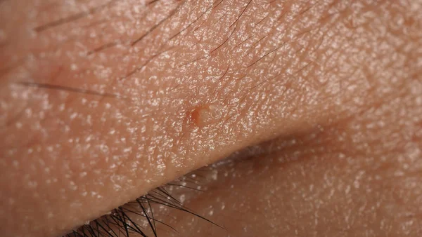 Wart Skin Removal Macro Shot Warts Eye Face Papilloma Skin — Stock Photo, Image