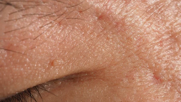 Wart Skin Removal Macro Shot Warts Eye Face Papilloma Skin — стоковое фото
