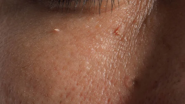Wart Skin Removal Macro Shot Warts Eye Face Papilloma Skin — ストック写真