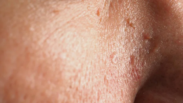 Wart Skin Removal Macro Shot Warts Eye Face Papilloma Skin —  Fotos de Stock