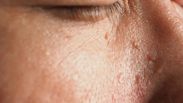 Siğil aldırma. Yüzüne yakın siğillerin makro görüntüsü. Göz ve boyun çevresinde papilloma var. Doğum lekesi Papilla ya da derisindeki ben. Küçük sert. Virüsün neden olduğu deride iyi huylu bir büyüme. Cilt bakımı