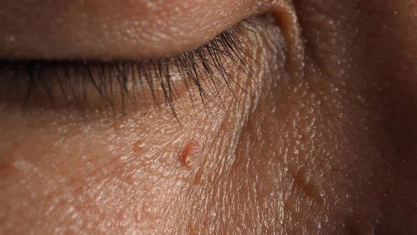 Pengangkatan Kulit Wart Tembakan Makro Kutil Dekat Mata Pada Wajah — Stok Foto