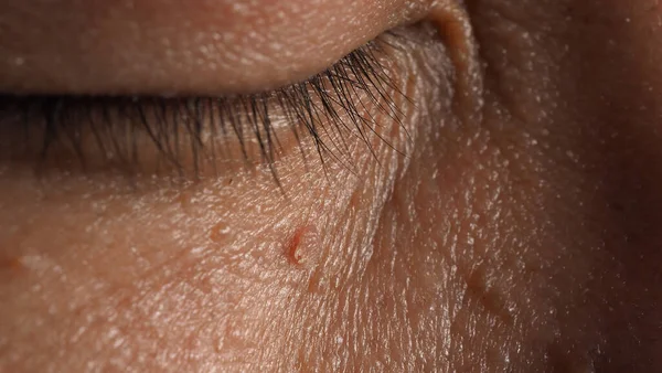 Enlèvement Des Verrues Plan Macro Verrues Près Œil Sur Visage — Photo