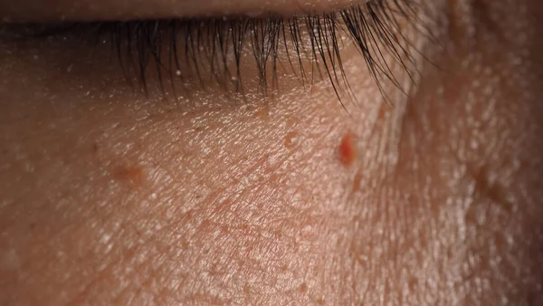 Wart Skin Removal Macro Shot Warts Eye Face Papilloma Skin — Stock Photo, Image