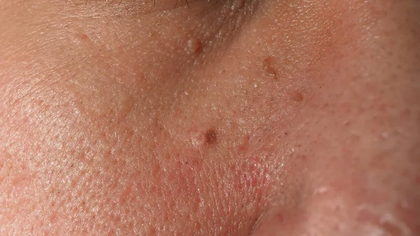 Wart Skin Removal Macro Shot Warts Eye Face Papilloma Skin — Foto de Stock