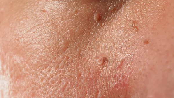 Wart Skin Removal Macro Shot Warts Eye Face Papilloma Skin — Photo