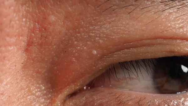 Wart Skin Removal Macro Shot Warts Eye Face Papilloma Skin — стоковое фото