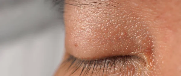 Wart Skin Removal Macro Shot Warts Eye Face Papilloma Skin — 스톡 사진