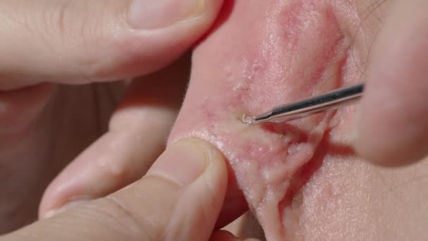 Behandelingsbeelden Van Acne Squeezing Blackhead Puist Met Roestvrij Staal Medische — Stockvideo