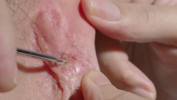 Behandelingsbeelden Van Acne Squeezing Blackhead Puist Met Roestvrij Staal Medische — Stockvideo