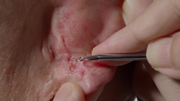 Akne Behandlung Filmmaterial Mitesser Pickel Mit Medizinischem Akne Entferner Aus — Stockvideo