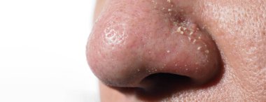 Sivilce ve sorun gözenekleri. Siyahi sivilceleri paslanmaz çelik sivilce çıkarıcı aletle sıkmak. Burun deliklerinden beyaz ve siyah sivilceler çıkıyor. Sivilce sorunu yakın plan. cilt bakımı.