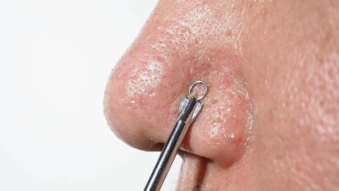 Sivilce ve sorun gözenekleri. Siyahi sivilceleri paslanmaz çelik sivilce çıkarıcı aletle sıkmak. Burun deliklerinden beyaz ve siyah sivilceler çıkıyor. Sivilce sorunu yakın plan. cilt bakımı.