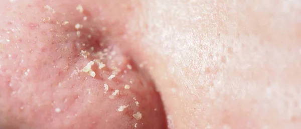 Acne Probleemporiën Squeezing Blackhead Puist Met Roestvrij Staal Medische Acne — Stockfoto