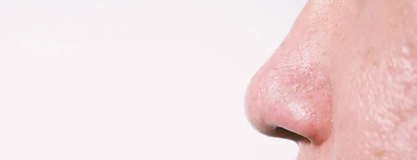 여드름 스테인리스 의료용 여드름 도구로 여드름을 코에난 상처에 과검은 여드름을 — 스톡 사진