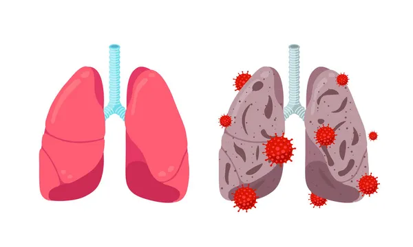 Protección saludable de las vacunas y pulmones poco saludables con infección por coronavirus. Órgano interno del sistema respiratorio humano con neumonía por virus corona. Infectado COVID-19 enfermedad pulmonar ilustración — Archivo Imágenes Vectoriales