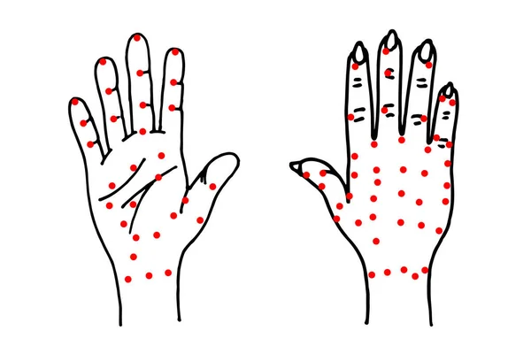 Hand palm and dorsal side sketch. Alternative medicine and treatment. Chinese red points acupuncture scheme drawing. Medical vector illustration — Stock vektor